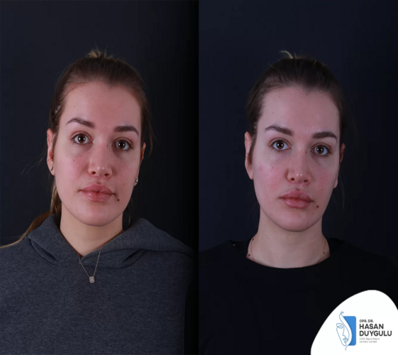 Bichectomia prima e dopo