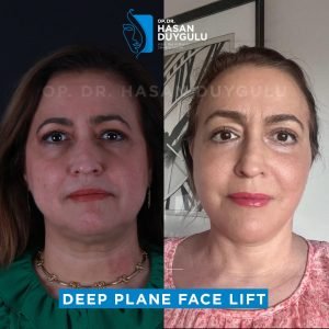 Lifting viso prima e dopo