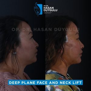 Lifting viso prima e dopo in Turchia
