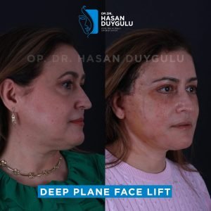 Lifting viso prima e dopo in Turchia