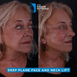 Foto prima e dopo del lifting facciale in Turchia