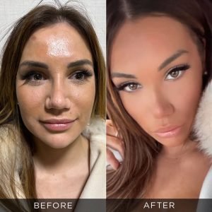 Foto prima e dopo del lifting facciale in Turchia