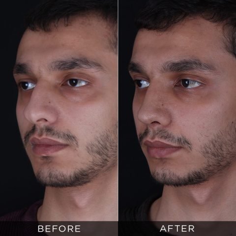 rinoplastica-maschile-prima-e-dopo-12