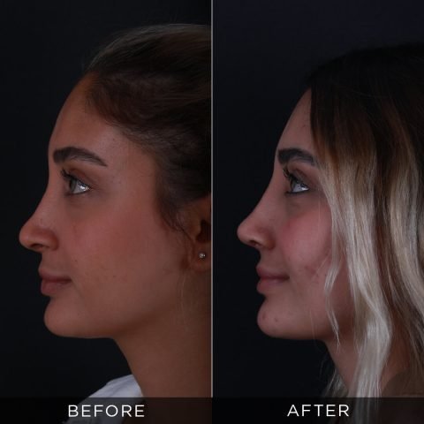 revision-rhinoplasty-before-after-2