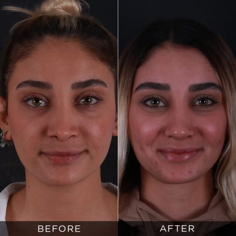 revision-rhinoplasty-before-after-3