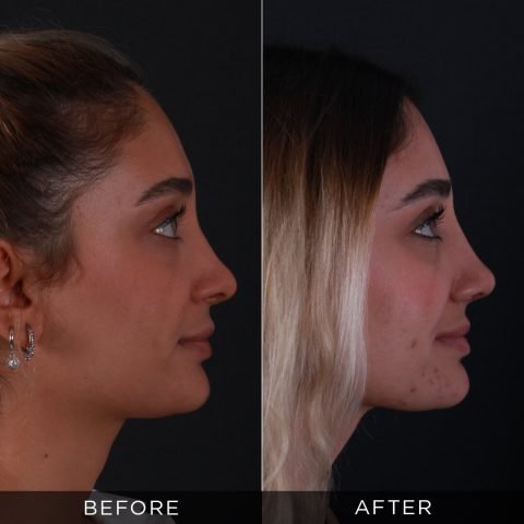 revisione-rinoplastica-prima-dopo-4