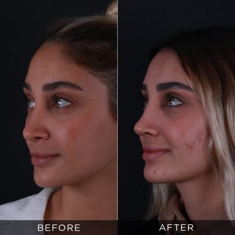 revision-rhinoplasty-before-after