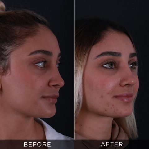 rinoplastica-di-revisione-prima-e-dopo-5