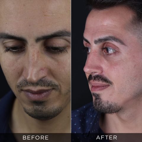 revision-rhinoplasty-before-and-after-10
