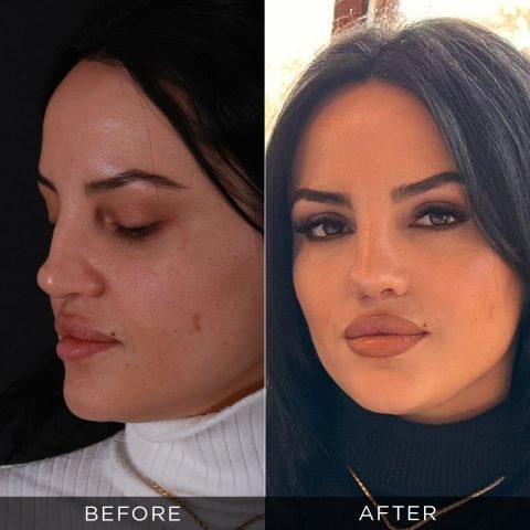 revision-rhinoplasty-before-and-after-16