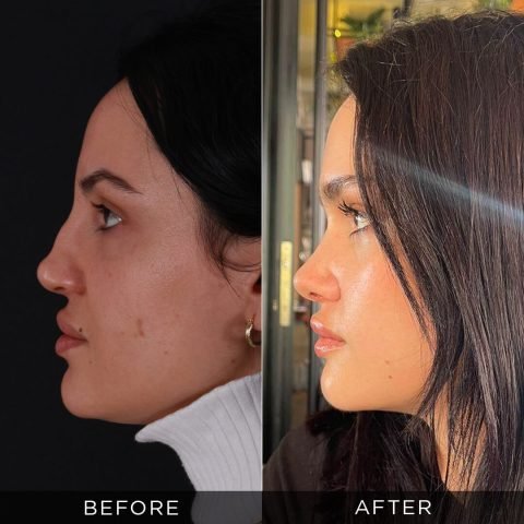 revision-rhinoplasty-before-and-after-17