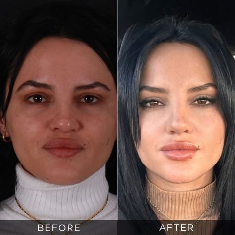 revision-rhinoplasty-before-and-after-18