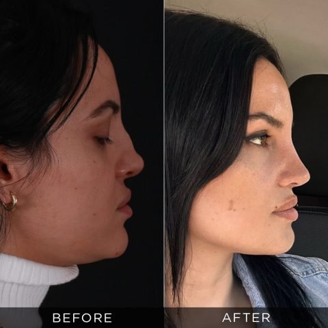 revision-rhinoplasty-before-and-after-19