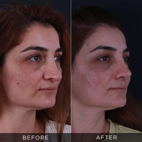 rinoplastica-di-revisione-prima-e-dopo-3