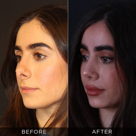 rinoplastica-di-revisione-prima-e-dopo-4