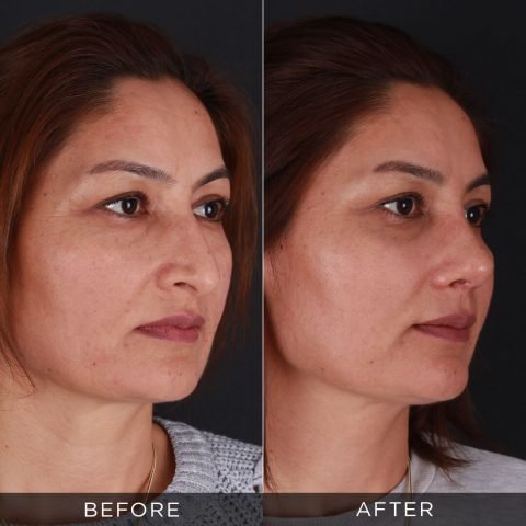 Rinoplastica 1 mese post-operatorio