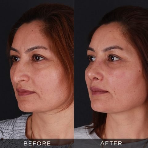 Rinoplastica 1 mese dopo l'intervento