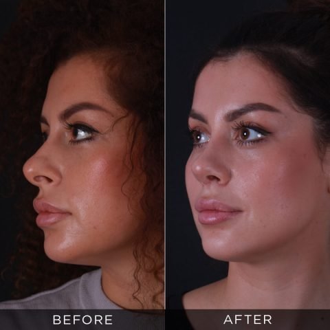 Rinoplastica 6 mesi dopo