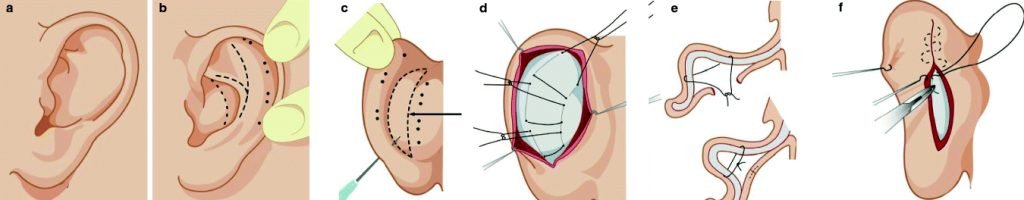 Qual è il processo di guarigione dopo l'intervento di otoplastica?