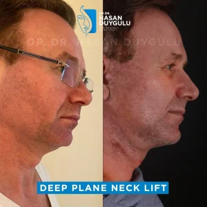 lifting-facciale-deep-plane-uomo-istanbul-immagini