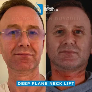 lifting-facciale-deep-plane-uomo-turchia-immagini