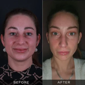 Foto prima e dopo l'intervento agli occhi a mandorla in Turchia