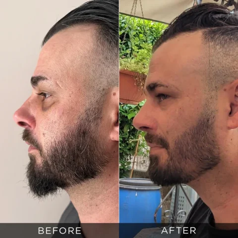 uomini-revisione-rinoplastica-prima-dopo-ottimizzata