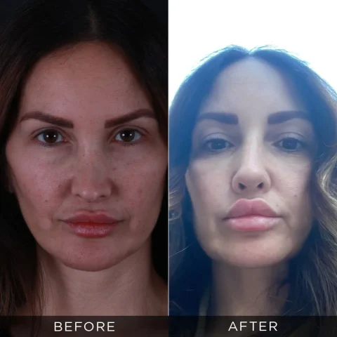 revisione-rinoplastica-prima-dopo-20-ottimizzata