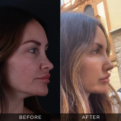 rinoplastica-di-revisione-prima-e-dopo-21-ottimizzata