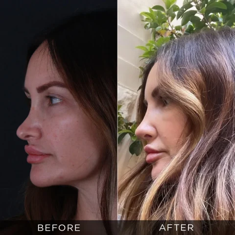 revisione-rinoplastica-prima-dopo-22-ottimizzata