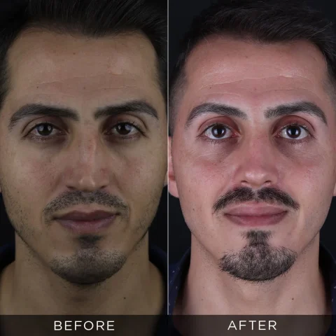 rinoplastica-di-revisione-prima-e-dopo-12-ottimizzata