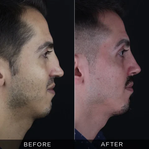 rinoplastica-di-revisione-prima-e-dopo-13-ottimizzata