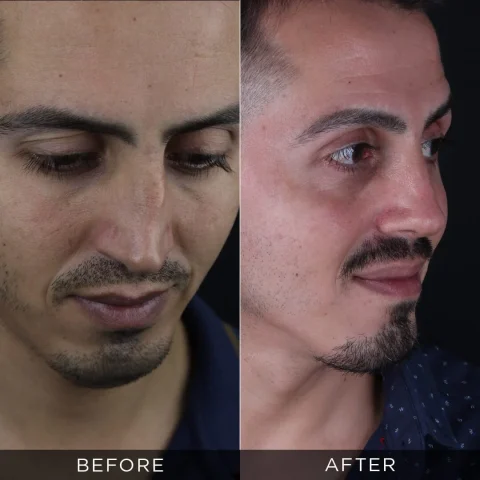 rinoplastica-di-revisione-prima-e-dopo-14-ottimizzata