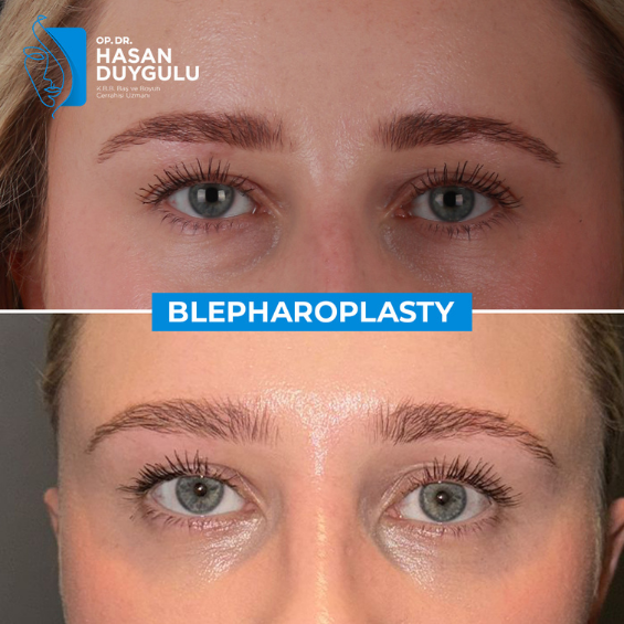 blefaroplastica-turchia-con-il-dott-hasan-duygulu