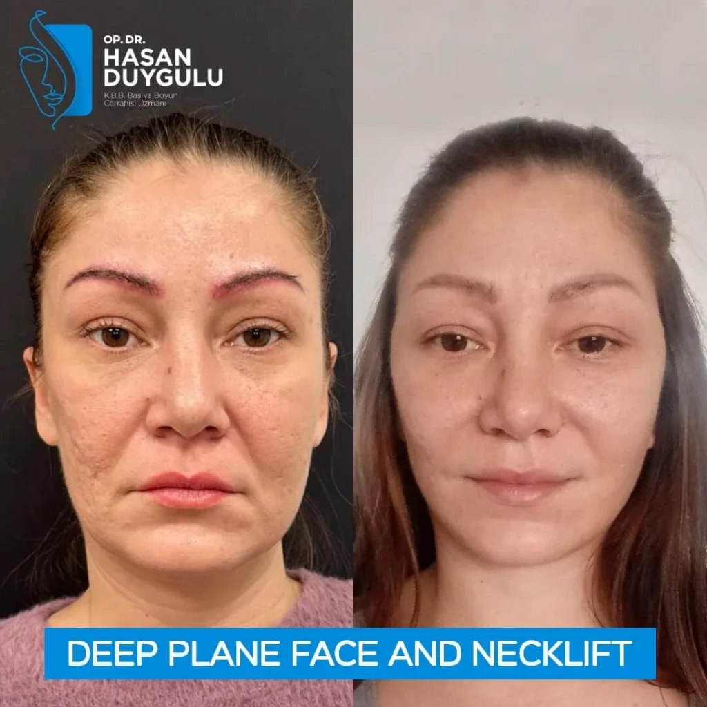 deep-plane-face-lift-before-after-photos