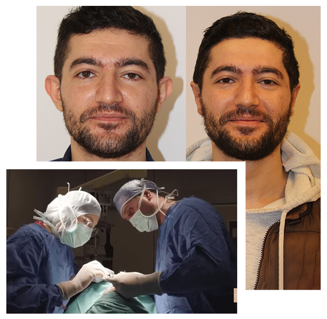 Chirurgia di otoplastica in Turchia (estetica dell'orecchio)