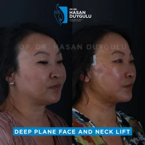 Galleria lifting del collo Turchia e foto prima e dopo