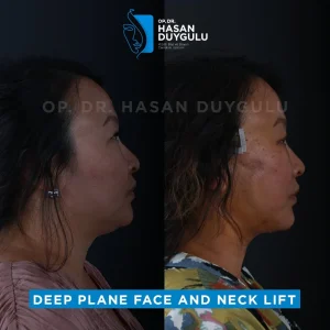 Galleria lifting del collo Turchia e foto prima e dopo