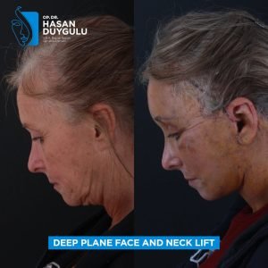 Foto prima e dopo del lifting facciale in Turchia