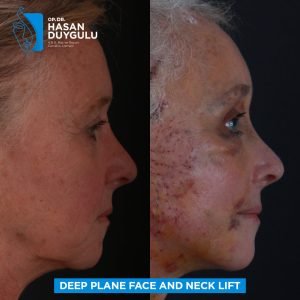 Foto prima e dopo del lifting facciale in Turchia