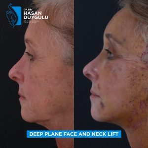 Foto prima e dopo del lifting facciale in Turchia