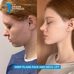 Galleria lifting del collo Turchia e foto prima e dopo