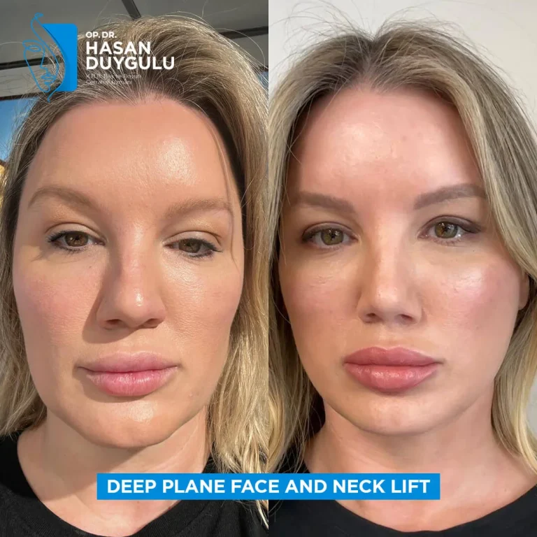 face-lift-women-in-turkey