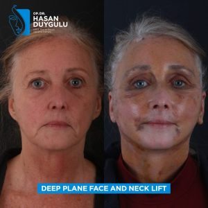 Foto prima e dopo del lifting facciale in Turchia
