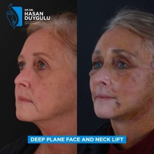 Foto prima e dopo del lifting facciale in Turchia
