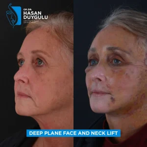 Galleria lifting del collo Turchia e foto prima e dopo