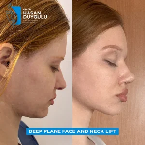 Galleria lifting del collo Turchia e foto prima e dopo