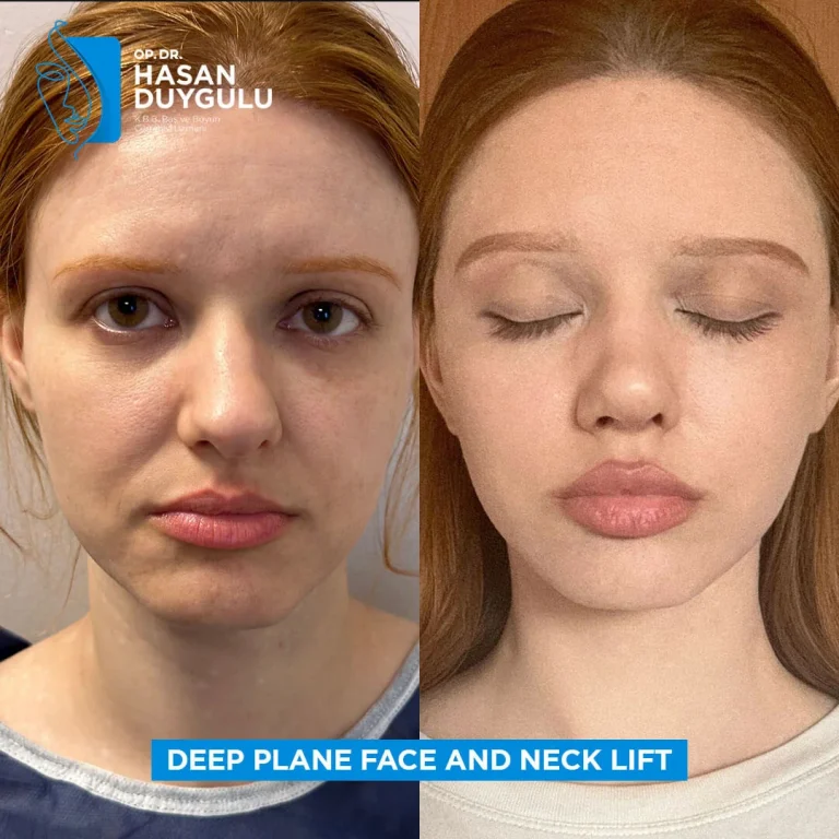 facelift-women-in-istanbul