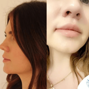 lifting-delle-labbra-donna-in-turchia