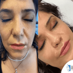 lip-lift-female-in-istanbul